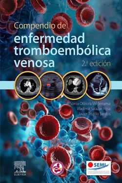 Compendio de Enfermedad Tromboembólica Venosa